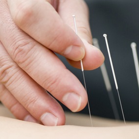 dry needling adelaide