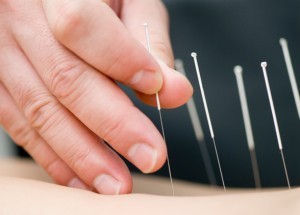 physio-adelaide-south-australia-acupuncture-dry-needling-300x215
